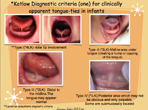 Tethered Oral Tissue (TOTs) aka “These tongue ties I keep hearing and reading about”