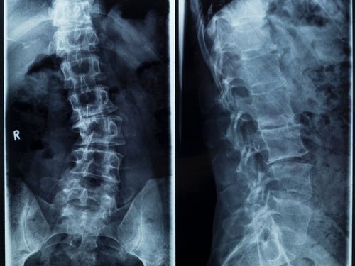 How To Prevent Scoliosis From How Getting Worse